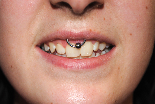 Smilie piercing featuring a captive bead ring.